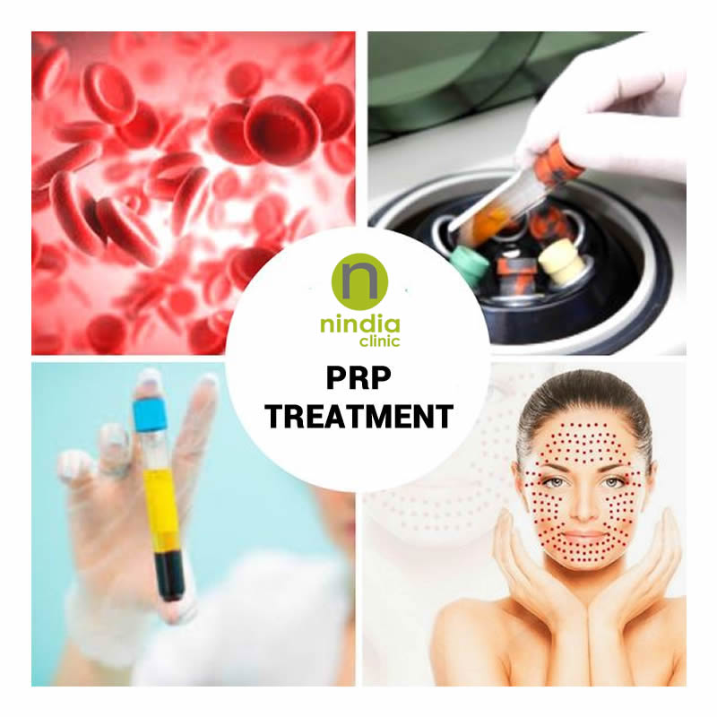 Platelet Rich Plasma - PRP