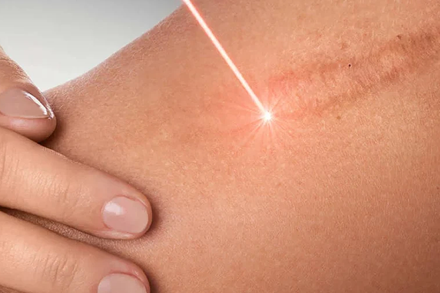 Treatment Bekas Luka